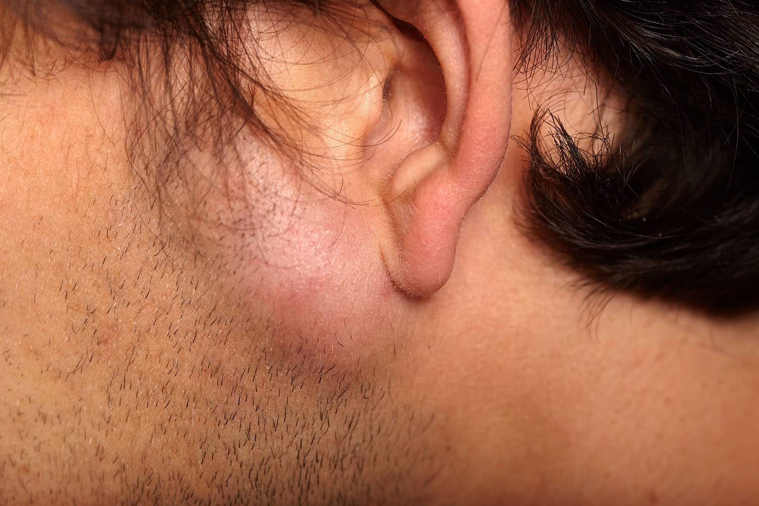 Cyst / Lipoma Removal